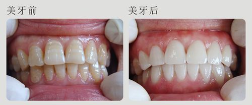 四环素牙怎么美白效果好？