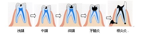 老年人患龋齿有哪些危害？