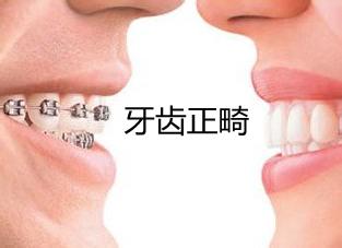 牙齿正畸治疗后为什么会复发？