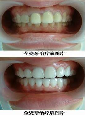 门牙选择哪种烤瓷牙修复比较好？