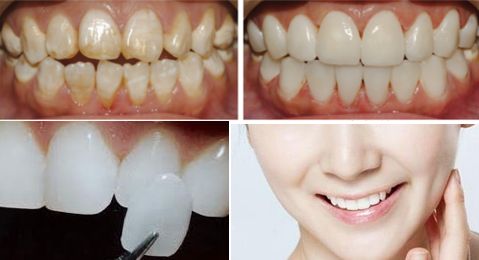 牙齿贴面的美白效果怎么样？