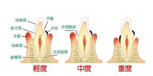 哪些症状表明患有牙周炎？