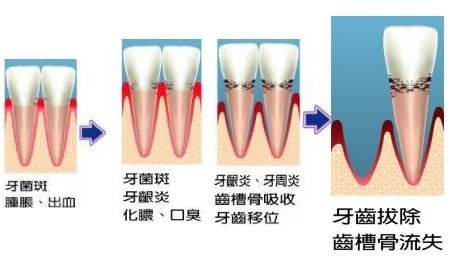 孕期常见的牙周问题有哪些？