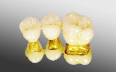 黄金烤瓷牙优缺点