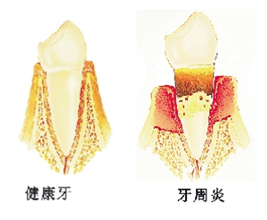 牙周炎犯了怎么办？