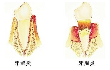 牙龈炎和牙周炎的区别有哪些？