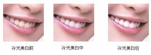 冷光美白牙齿要多少钱？