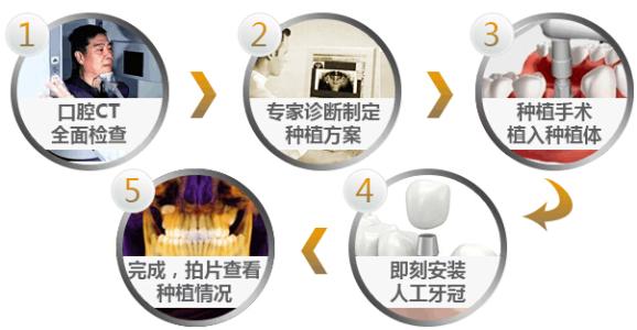 种植牙的过程是什么样的？
