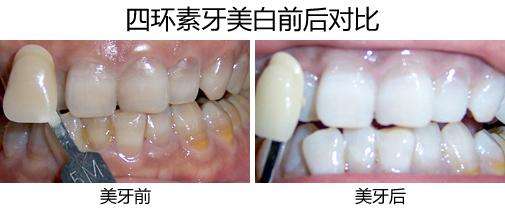 四环素牙如何变白？
