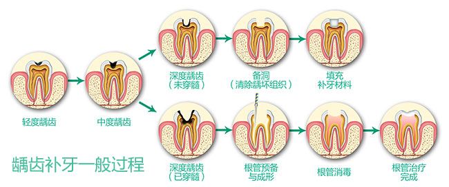 深圳补牙多少钱？