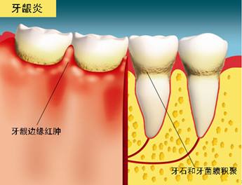 深圳牙龈出血是什么原因？