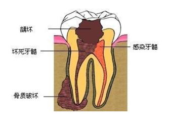 深圳治疗急性牙髓炎的方法有哪些？