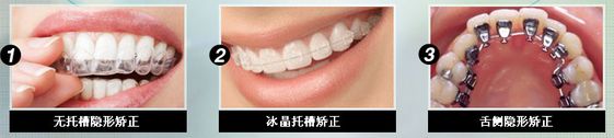 深圳隐形正畸需要多久？