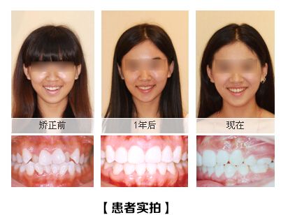 深圳牙齿不齐怎么办？