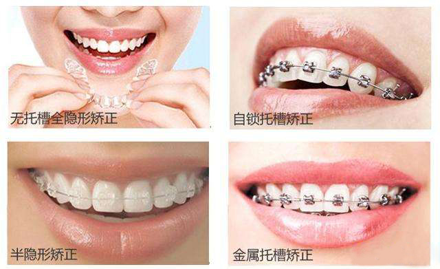 深圳牙齿不整齐矫正多少钱？