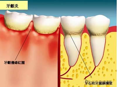 深圳孕妇牙龈炎怎么办？
