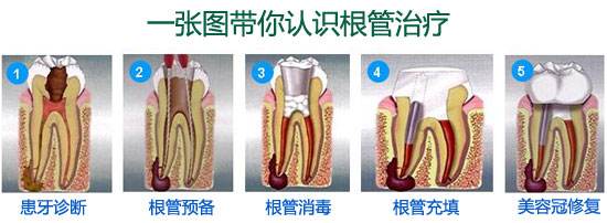 深圳做根管治疗步骤有哪些？