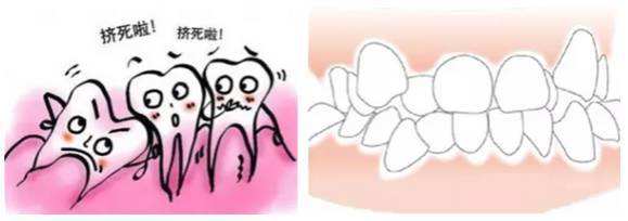 深圳智齿会使牙齿拥挤吗？