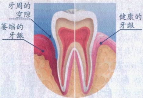 牙龈萎缩可以恢复吗？