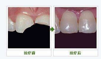 深圳牙齿断裂修复价格
