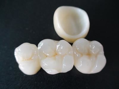 深圳全瓷牙多少钱一颗？