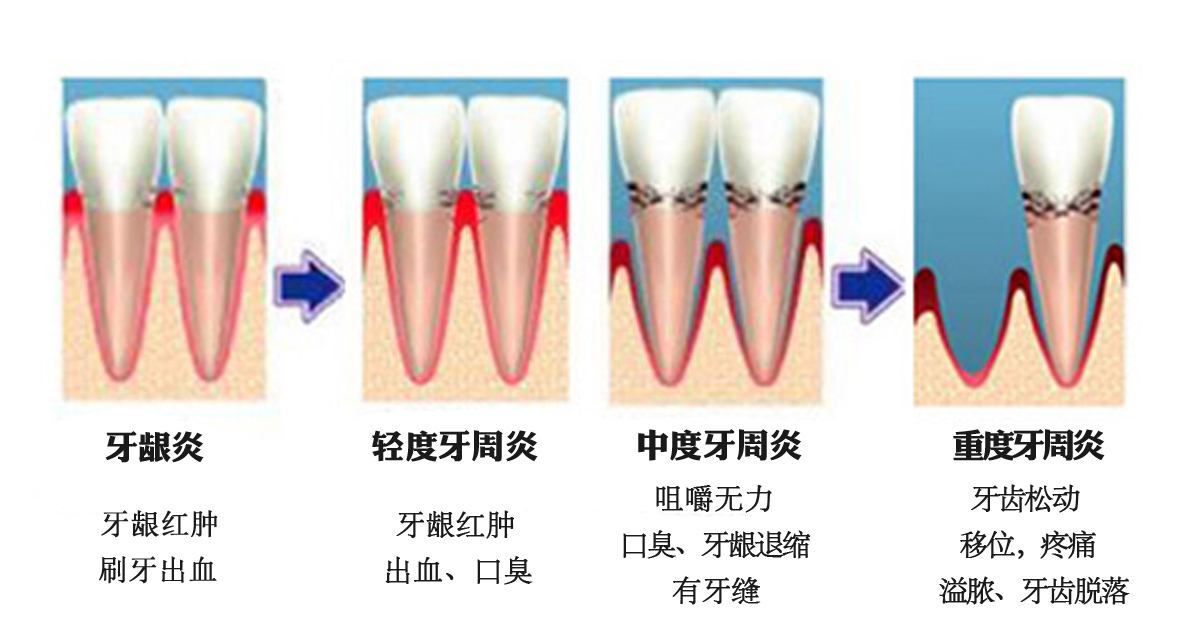 深圳牙周炎的治疗方法