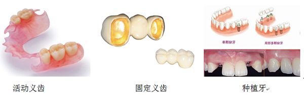 深圳镶牙过程要多久？