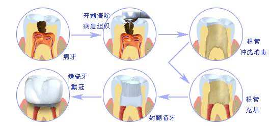 深圳牙髓炎根管治疗费用