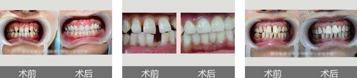 深圳牙齿稀疏牙缝大治疗多少钱？