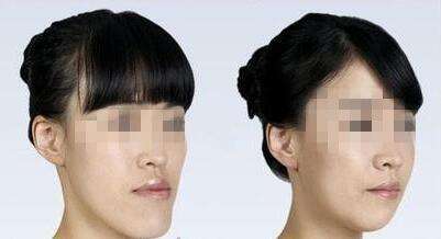 深圳矫正牙齿地包天方法有哪些？