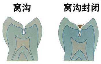 深圳窝沟封闭有必要吗？