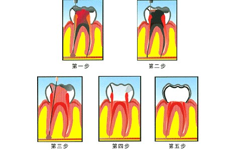 深圳牙齿做根管治疗需要多少钱？