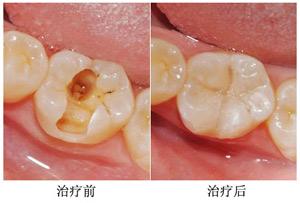 深圳蛀牙补一颗牙多少钱？