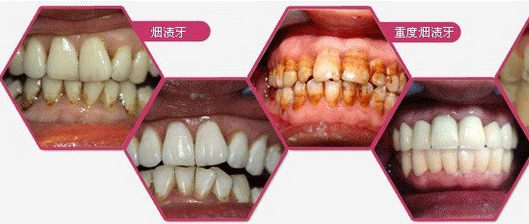 深圳烟渍牙怎么变白？