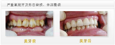 深圳氟斑牙治疗方法