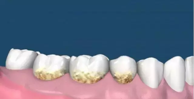 深圳牙结石怎么办？