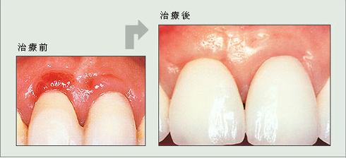 深圳镶牙齿后疼怎么办？
