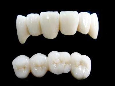 深圳全瓷烤瓷牙价格是多少？