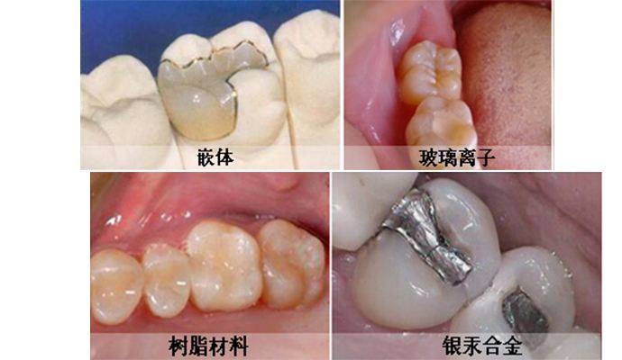 深圳补牙用什么材料较好? 深圳补牙用什么材料较好?
