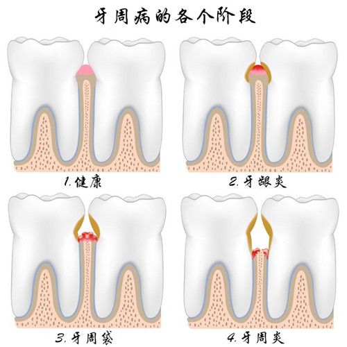 深圳孕妇牙周炎怎么办？