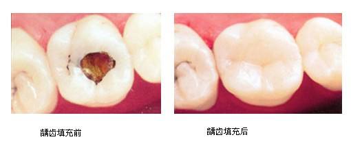 深圳龋齿牙洞填充要多少钱？