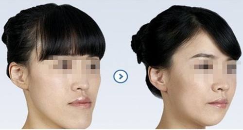 深圳地包天牙套多少钱？