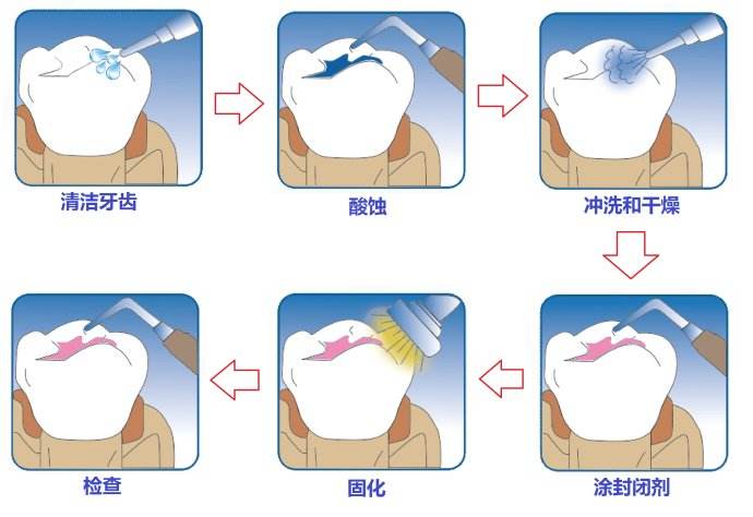 深圳怎么做窝沟封闭？