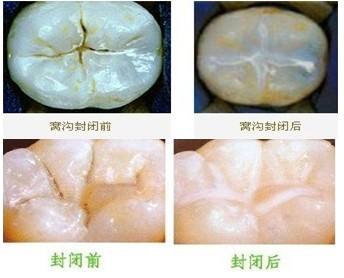 深圳牙齿窝沟封闭较佳时机