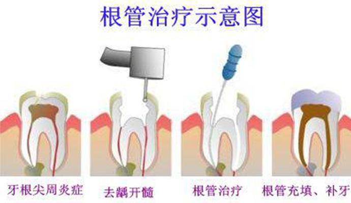 深圳牙齿根管治疗价格 深圳牙齿根管治疗价格