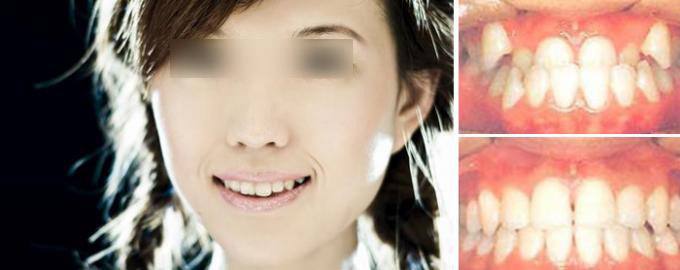 深圳牙齿拥挤矫正要多少钱？