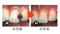 深圳宝宝门牙龋牙怎么办？