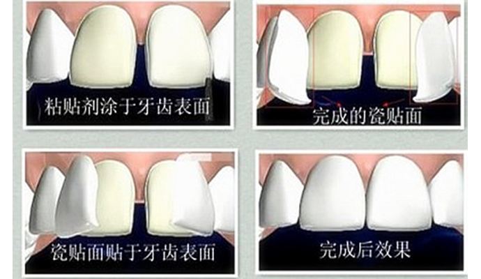 牙齿贴面矫正方法是怎样的？