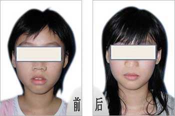 矫正龅牙疼吗？