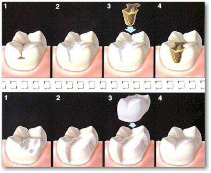 牙齿缺损该怎么办？